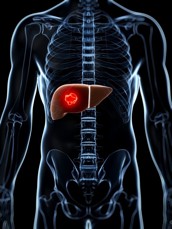 Cirrhosis and Liver Failure
